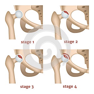aseptic necrosis. Stages of destruction of the femoral head. photo